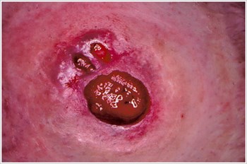 Pressure Ulcer