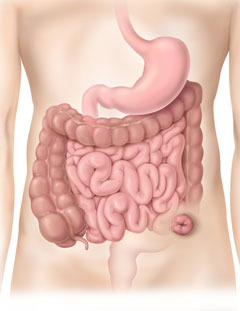 Colostom&iacute;a sigmoidea 