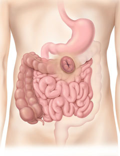 Colostom&iacute;a transversal